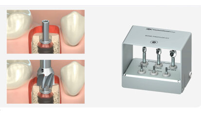 Keystone Dental Group – Conical Connection Bone Profiler Kit
