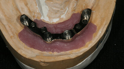 Barre fresate per overdenture: protocollo e procedure