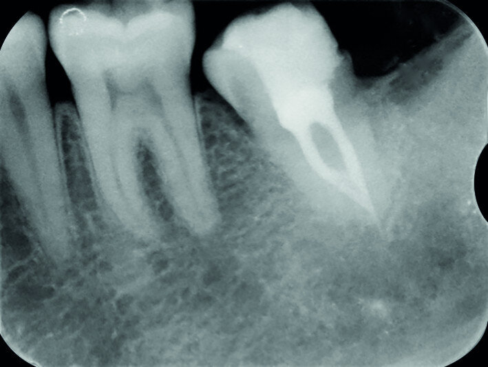 Fig. 15d: Radiograph: Twelve-year recall.