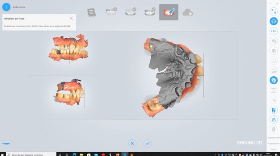 Figg. 13, 14_File STL ottenuti tramite scanner intraorale.