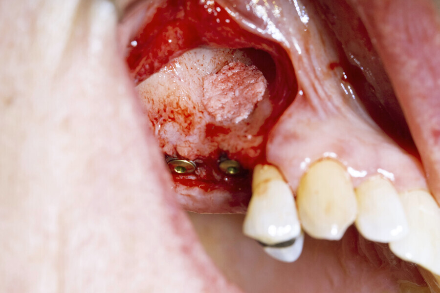 Fig. 7: Large quantity of autogenous bone collected from the BoneTrap.