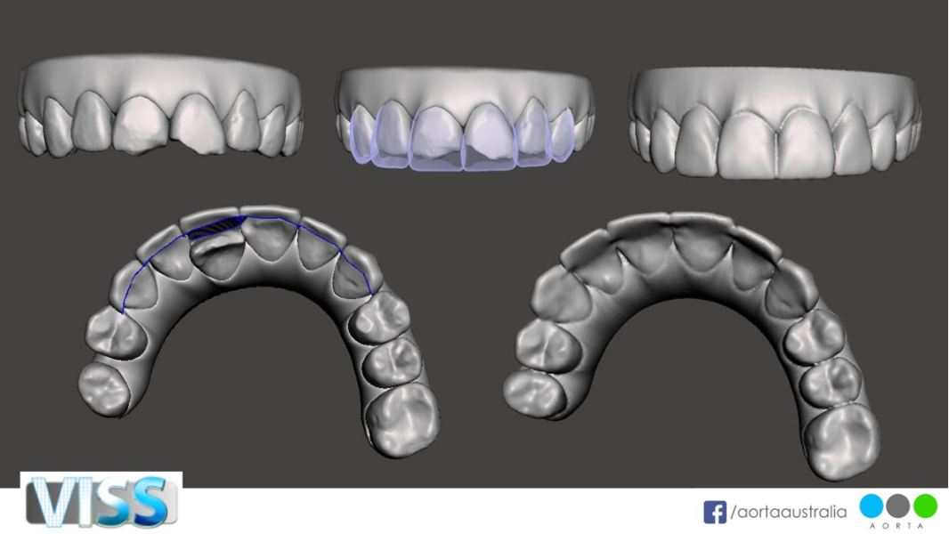 Figs. 36a–e: Simulated VISS images showing the situation pre-treatment (a), post-treatment (b & e) and after restorative treatment (purple; c & d).