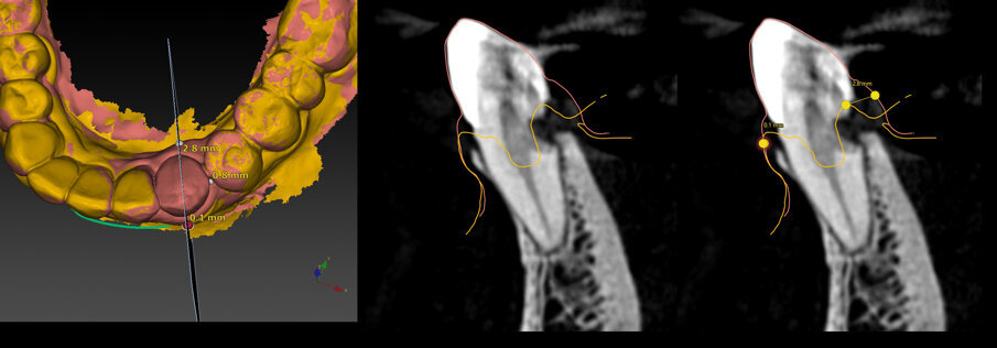 ig. 21_Matching degli STL pre e post, per la valutazione delle effettive modifiche dei tessuti molli: a fronte di un pieno mantenimento a livello vestibolare, si apprezza un’importante contrazione a livello linguale, pari a 2,8 mm, e dovuta alla completa perdita del legamento parodontale su tale versante.