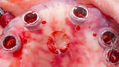 Arcate superiore e inferiore riabilitate con Chirurgia Guidata Simultanea full arch