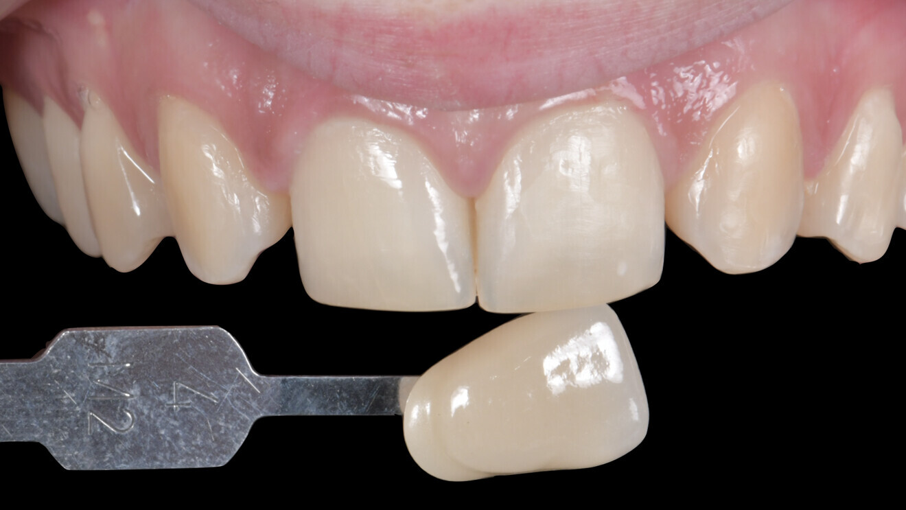 Fig. 3 : Relevé de couleur initial (4M2). Il est capital de relever la couleur des dents avant de commencer un traitement d’éclaircissement.  Pour cela un relevé à l’aide d’un teintier VITA Bleachedguide 3D-MASTER est nécessaire avec conservation de la référence dans le dossier du patient.