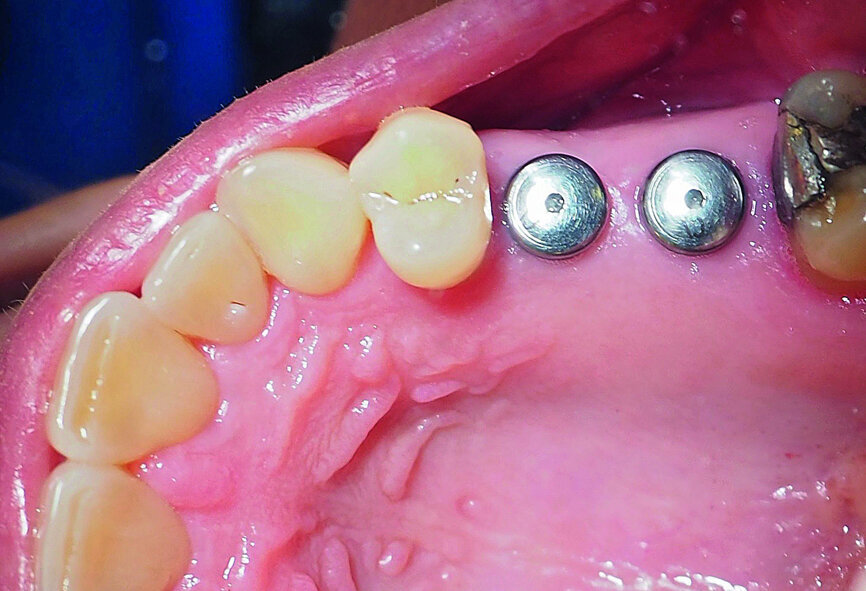 Fig. 20: Sulcus formers prior to fitting of the final restorations.