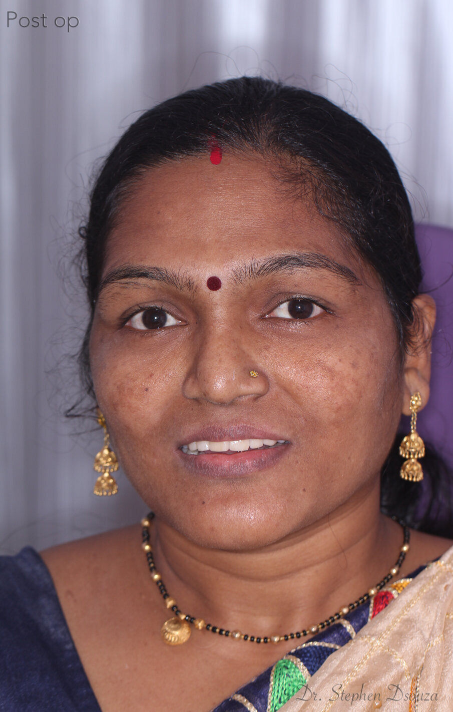 Fig. 16: Post-operative smile.