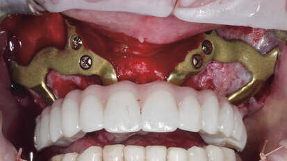 Quelle alternative à l’implantologie conventionnelle — implant zygomatique ou implant sous périosté ?