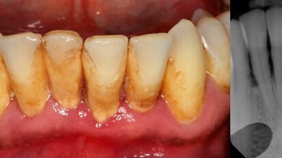 Allogenic stem cells – a faster and cheaper method to treat periodontitis