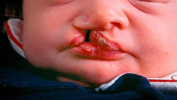 „Wir haben eine Region auf Chromosom 8 identifiziert, quasi das Haupt-Gen für Lippen-Kiefer-Gaumenspalten.“