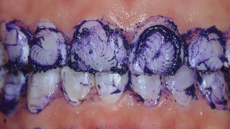 Foto 6. Microabrasión con Opalustre (Ultradent).
