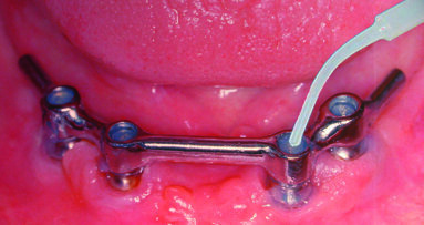 Periodontitis and peri-implantitis prophylaxis through sealing the superstructures