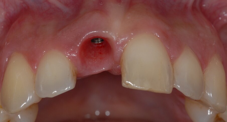 Fig. 5 - I tessuti perimplantari a un anno dall’intervento sono molto belli sia per forma che per tono e stato di salute. Le papille sono competenti e la parabola è simmetrica a quella dell’elemento adiacente. La bozza radicolare è molto ben conservata (Root Bump Preservation RBP).
