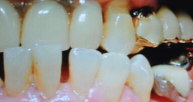 Non solo batteri ma trauma occlusale all’origine della malattia parodontale