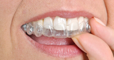 Η αγορά των διάφανων ορθοδοντικών μηχανημάτων θα αναπτυχτεί ραγδαία τα επόμενα 5 χρόνια