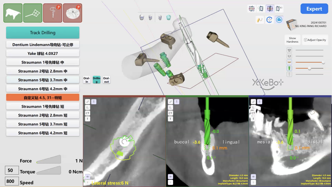 Fig. 10: Robotic tracking interface displaying real-time verification of osteotomy depth and position in multiple planes relative to the planned osteotomy trajectory. 