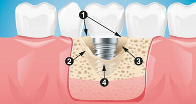 Proposition d’une nouvelle classification diagnostique et thérapeutique des péri-implantites