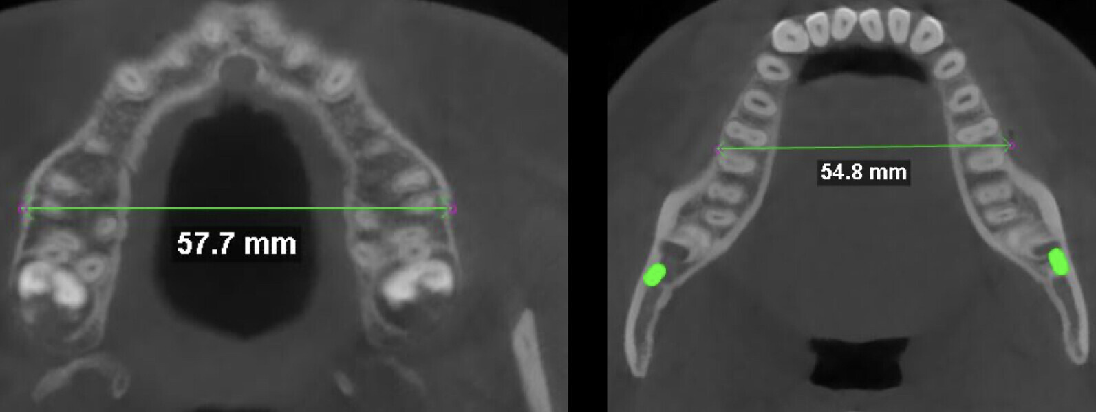 Fig. 5: Penn transverse analysis of the CBCT scan.
