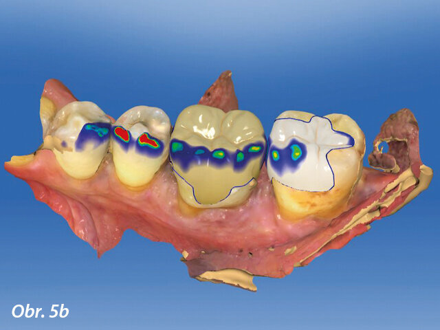 CAD výroba v dolní čelisti.