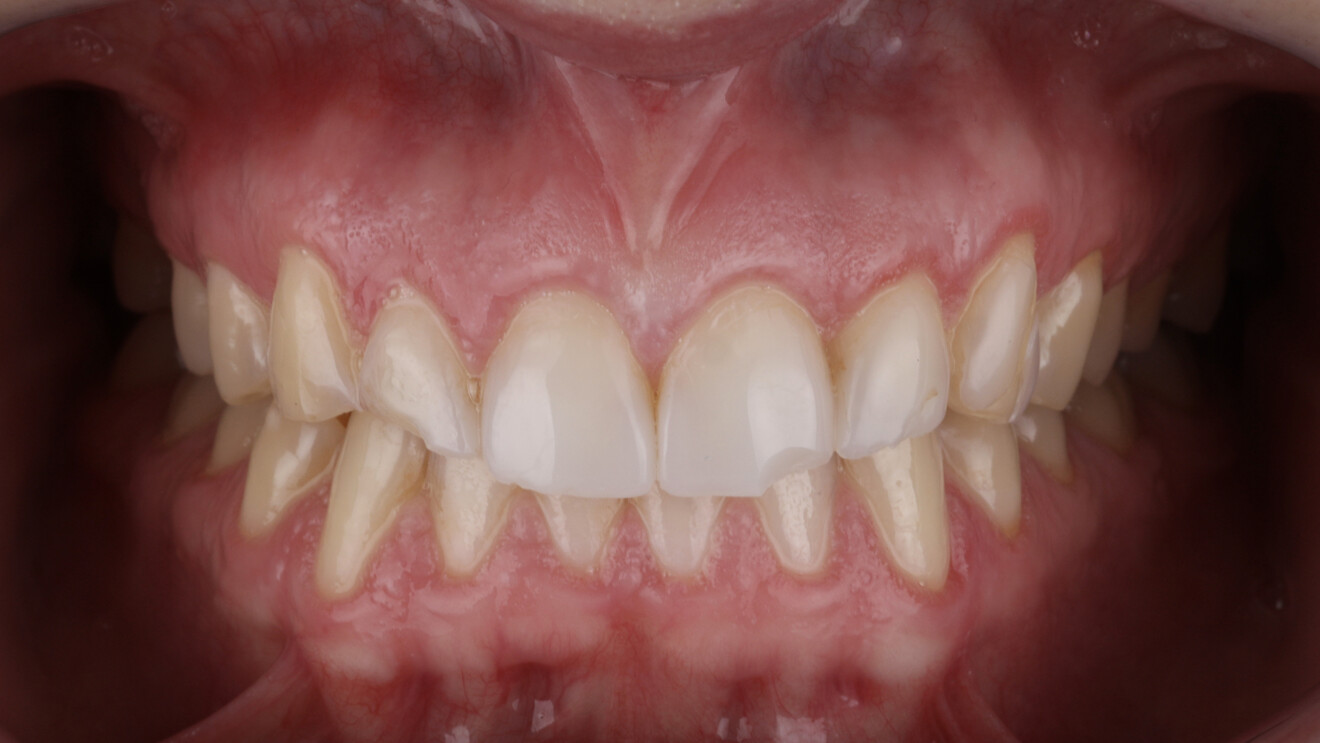 Fig. 1e: Intra-oral frontal view with the teeth in intercuspation.