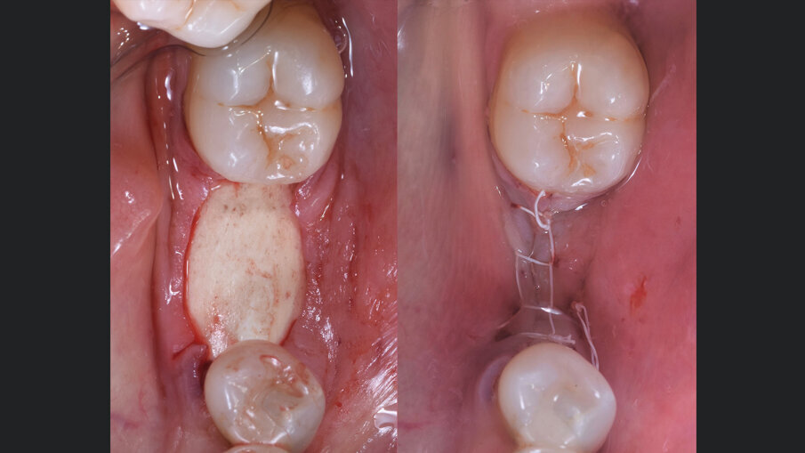 Fig. 4 - Riempimento del difetto e sutura del lembo a permettere una guarigione per prima intenzione.