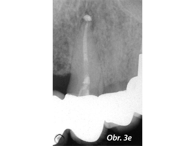 Postoperační RTG se zaplněným kanálkem