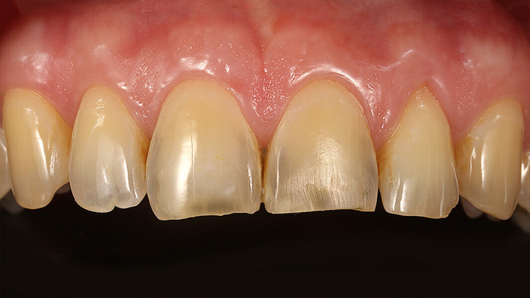 Fig. 1. Situación inicial: la erosión y la abrasión habían causado una reducción de la zona incisal y pérdida de la morfología de los dientes 11 y 21.