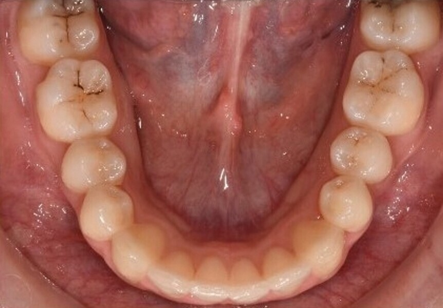 Fig. 6b : Photographie intraorale finale.