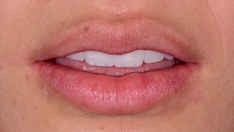 Realce de labios en la consulta odontológica