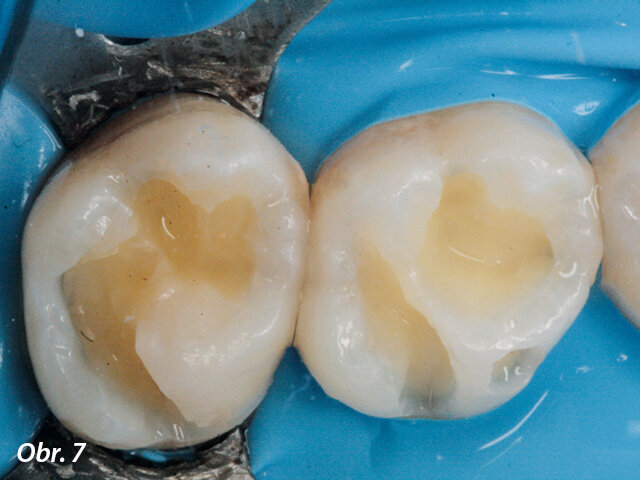 Preparace kavity v zubech 16, 17.