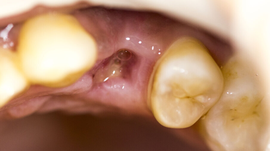 Fig. 10 - Rimozione della sutura dopo sei giorni.