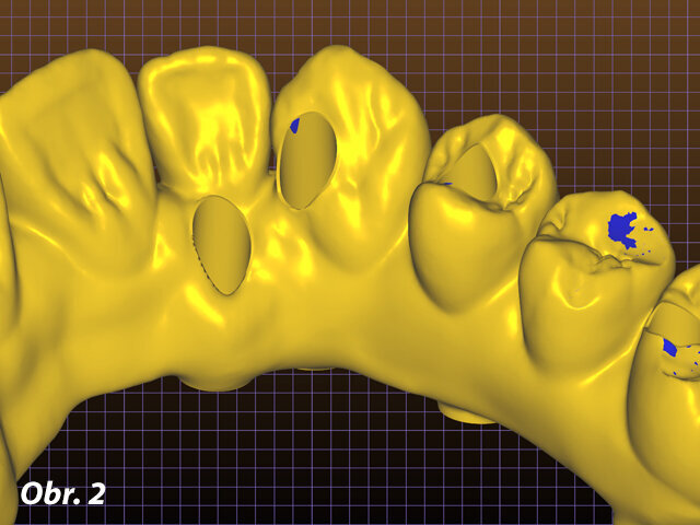 Náhrada PMMA je provizorium, které slouží k testování dosedů, anatomie a upřesňuje okluzní vztahy – štoly nejsou angulované. Na zubu číslo 23 je vidět otvor v incizní oblasti a je vizualizován budoucí otvor definitivní náhrady.