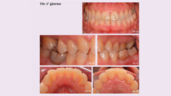 Trattamento di una Parodontite Stadio III Grado C con CHX 0,12%+CPC 0,05% e dentifricio Vitis  antistain