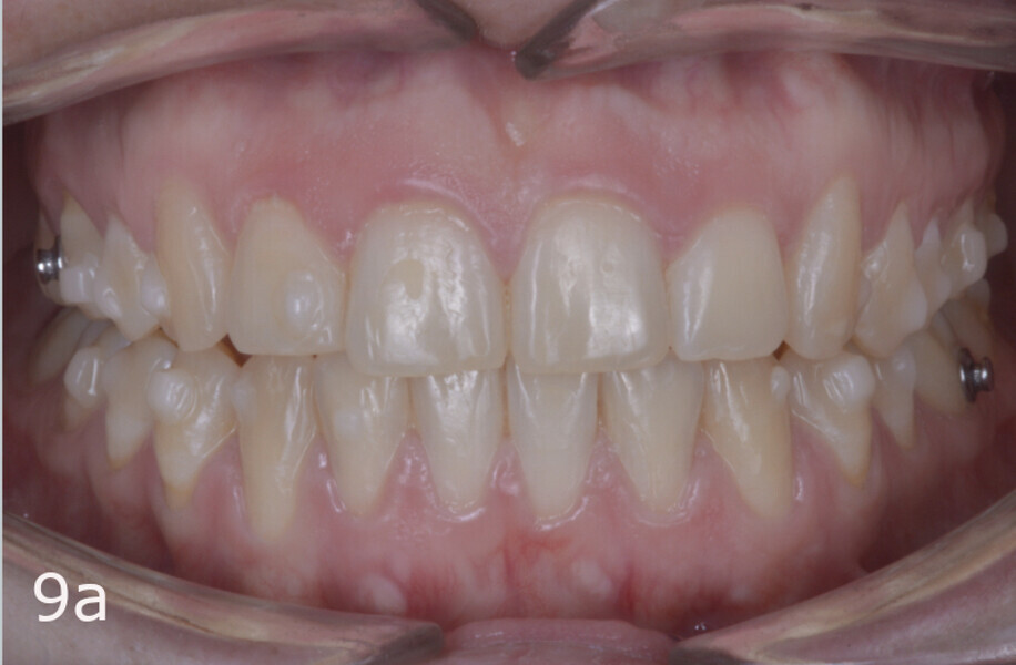 Figs. 9a–d: Situation after aligner set 60. The lack of overjet and overbite and the anterior open bite had been practically solved.