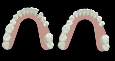 Space management in adults using CAD/CAM aligners―Three case reports