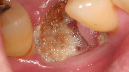 Study presents new treatment for jaw osteonecrosis around dental implants