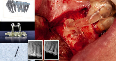 Dynamic navigation—The future of minimally invasive endodontics