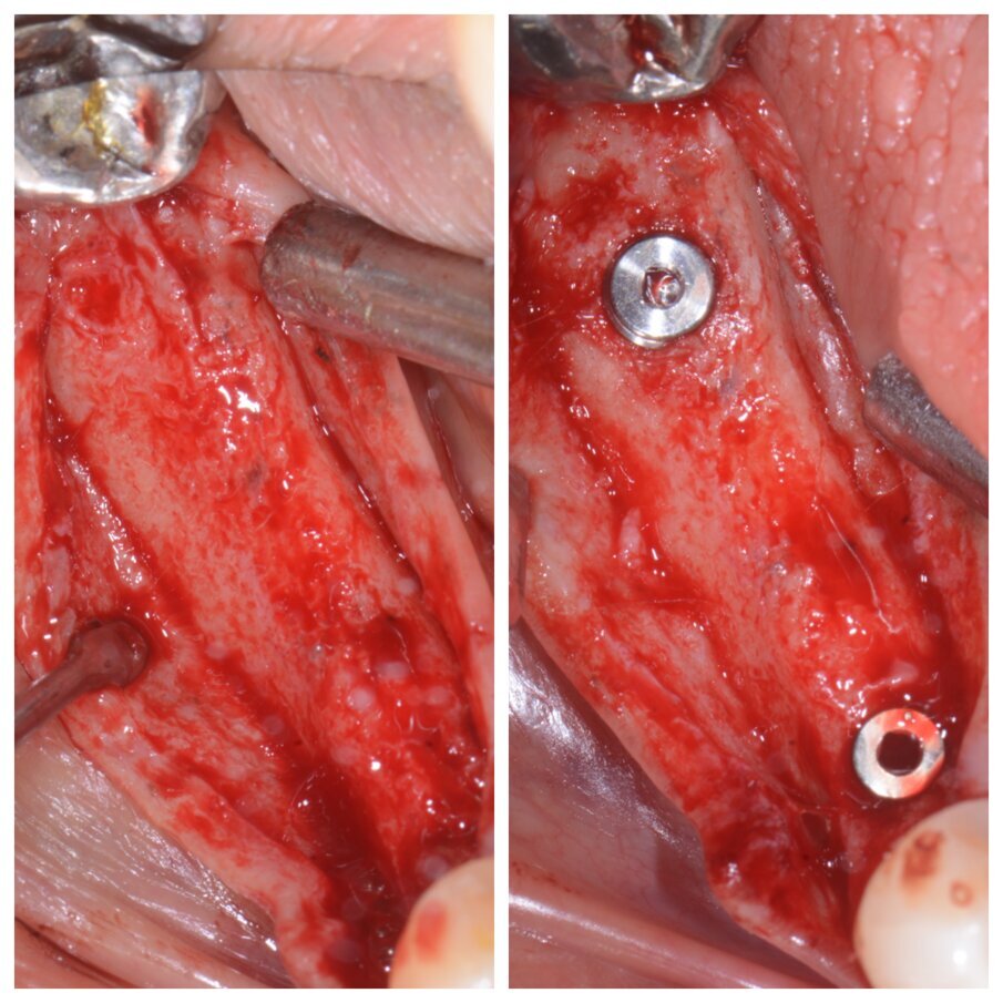 Fig. 3d_Qualità del tessuto neoformato e posizionamento implantare.