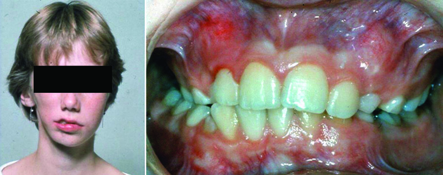 Figure 2. Facial photograph of a 13-year-old girl with hemifacial microsomia (right side) (a). The discrepancies include asymmetries in the mandibular body, ramus, and condyle, as well as involvement of the ear. Malocclusion is characterized by right posterior crossbite, tilting of the occlusal plane and lower dental midline deviation to the affected side (b).  