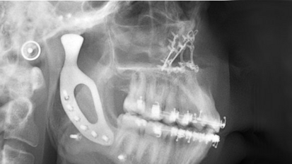 Implantan la primera articulación mandibular impresa en 3-D en Australia