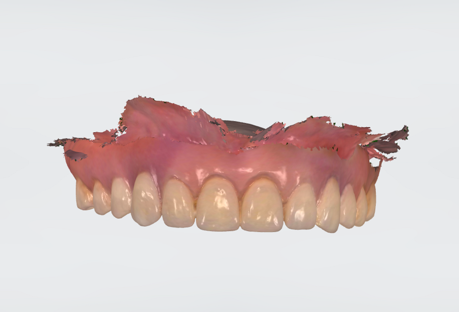 Fig. 6 - Scansione diretta in cavo orale della protesi totale esistente.