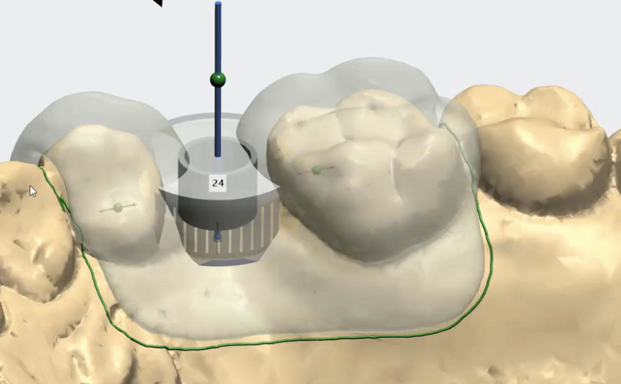 Fig. 9_La dima chirurgica progettata.