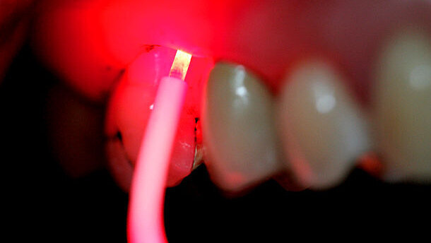 Antibakterielle Photodynamische Therapie – Standpunkt und Ausblick