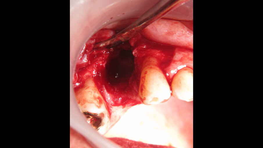 Situace defektu po explantaci a řízené kostní regeneraci u 67letého pacienta, který kouřil 42 cigaret denně a 27 let po implantaci trpěl
úbytkem kosti.