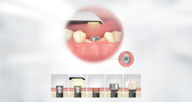 Osstem introduces the TS scan healing abutment for the European market
