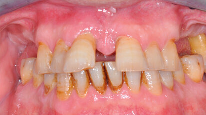 Riabilitazione a carico immediato  con impianti a connessione  conometrica: report di un caso  con due anni di follow-up