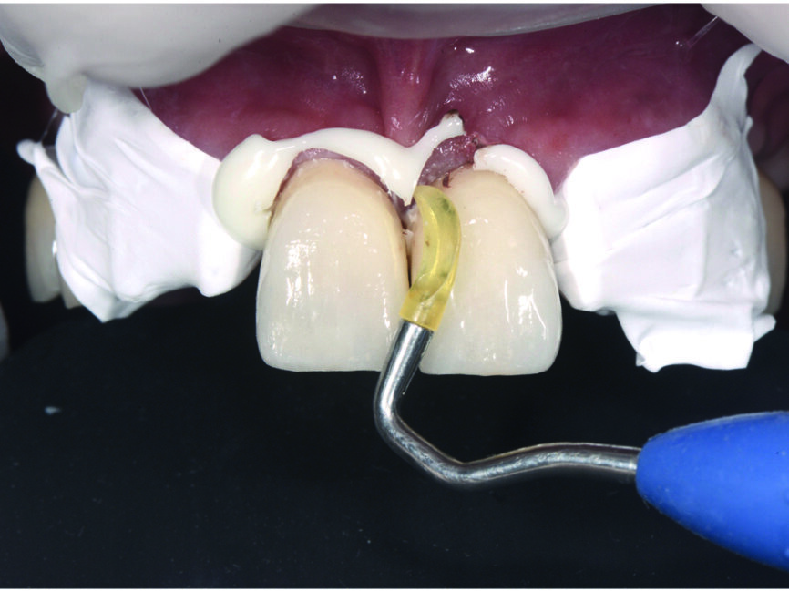 Fig. 10 : Élimination de l’excès de ciment cervical des incisives centrales. |