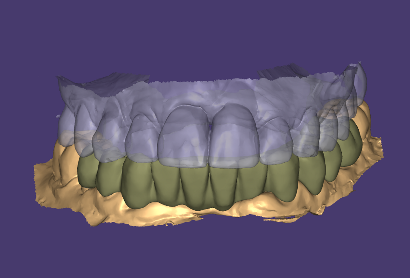 Fig. 5: Laboratory virtual mock-up of the temporary restoration. 