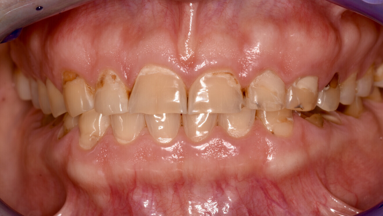 Fig. 1a: Initial situation. Recognisable loss of vertical dimension in the frontal view. 