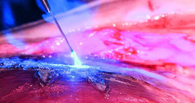 Dental laser market grows steadily